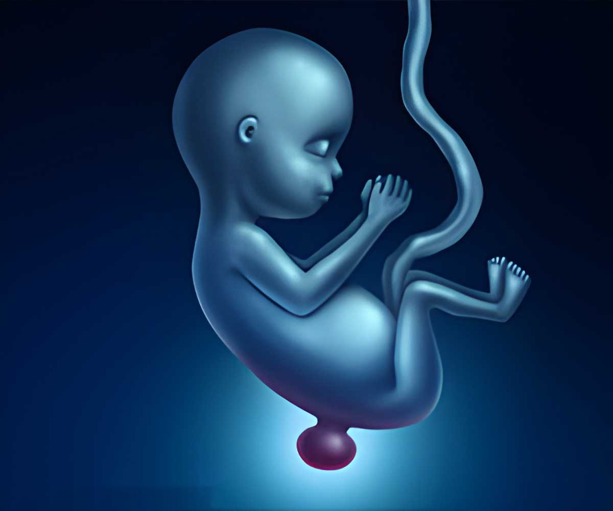 Birth deformity, myelomeningocele in baby