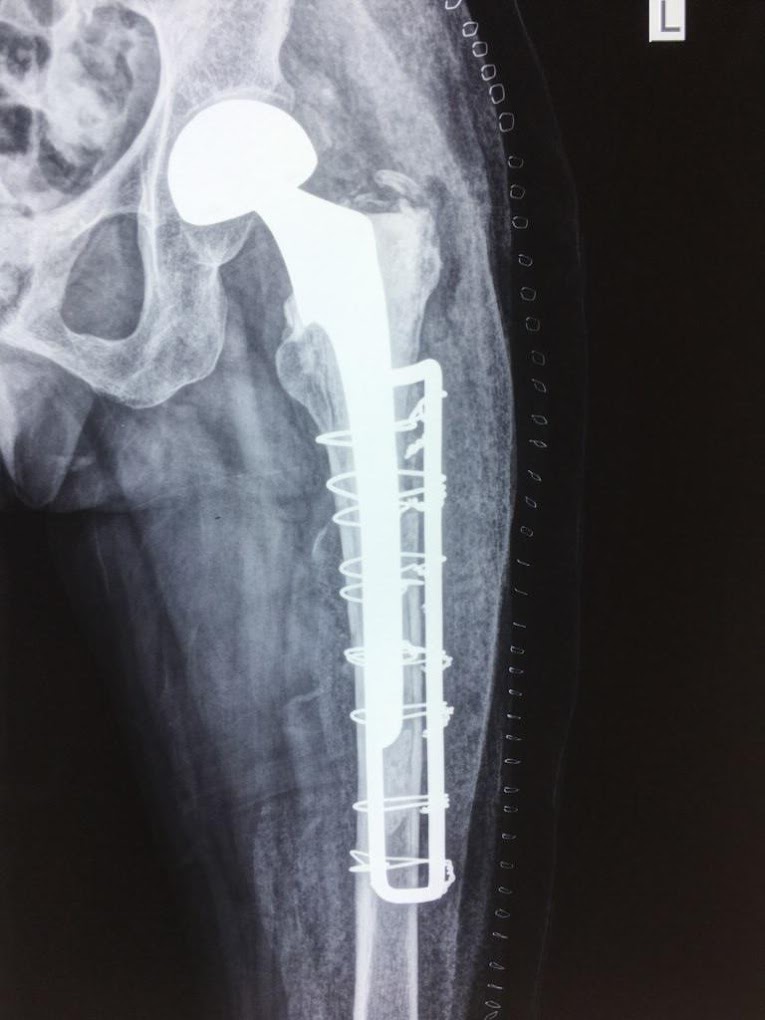 Total hip replacement x-ray